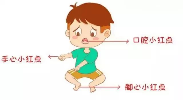 手足口病高发怎么防护看这里,现在是手足口病高发季怎么预防