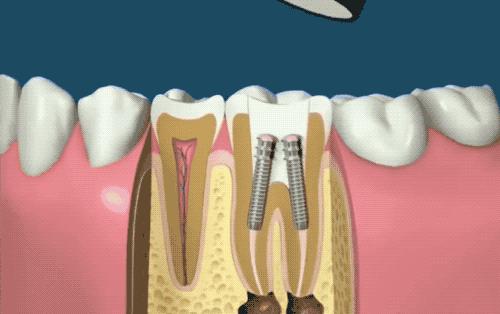 根管治疗没那么可怕,根管治疗有什么意义吗