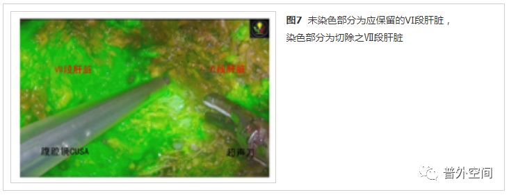 吲哚菁绿荧光引导腹腔镜解剖性肝脏Ⅶ段切除手术流程