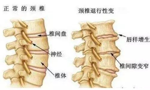 颈椎骨质增生看病经验分享,颈椎康复科普类短视频