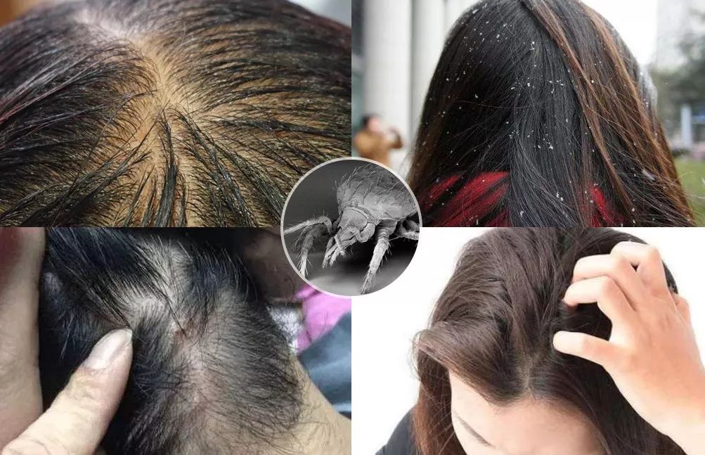 头皮除螨虫神器哪种好用,头皮除螨推荐控油产品吗