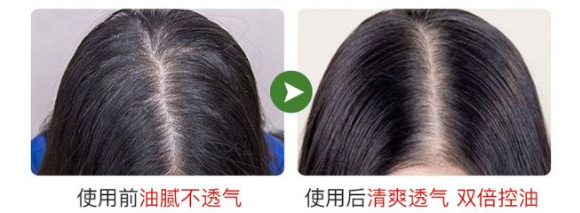 头皮除螨虫神器哪种好用,头皮除螨推荐控油产品吗