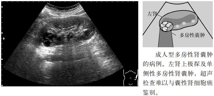 肾盏憩室和肾囊肿b超表现,肾盏憩室误诊肾囊肿案例