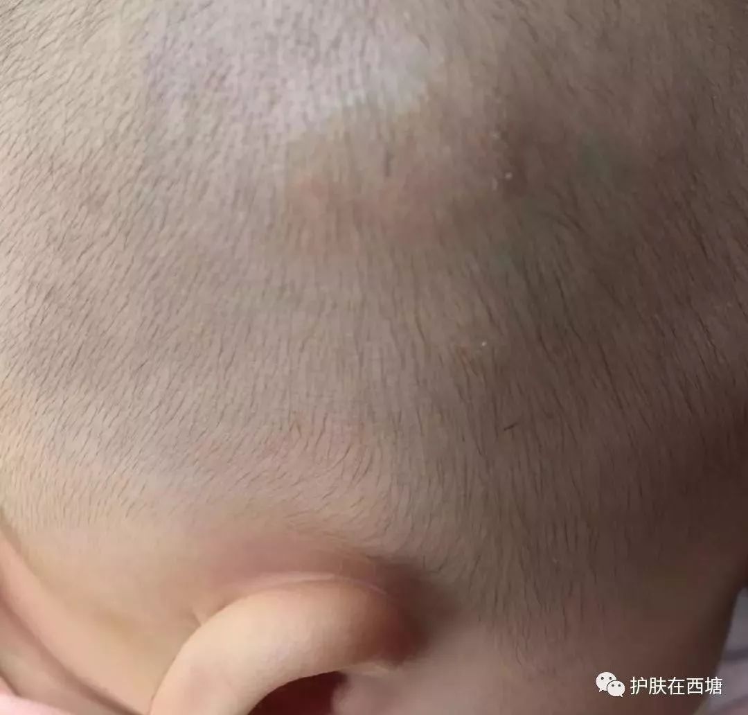 他克莫司软膏治疗脂溢性皮炎,面部皮肤脂溢性皮炎治疗方法