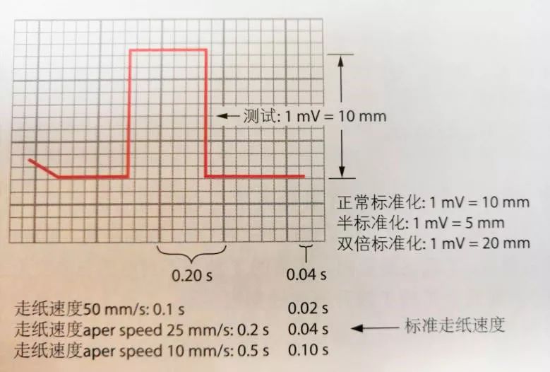 心电图上一个小格代表什么,心电图上有小波动你会怎么样