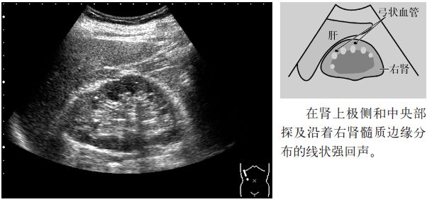 肾结石图片输尿管结石症状,输尿管上段结石超声碎石危害大么