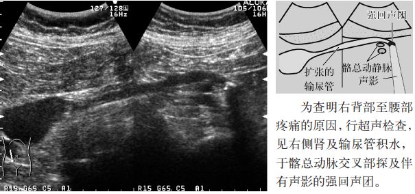 肾结石图片输尿管结石症状,输尿管上段结石超声碎石危害大么