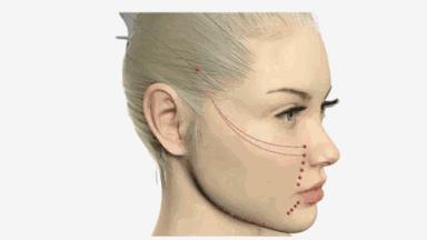 不削骨改变脸型,不削骨变脸型