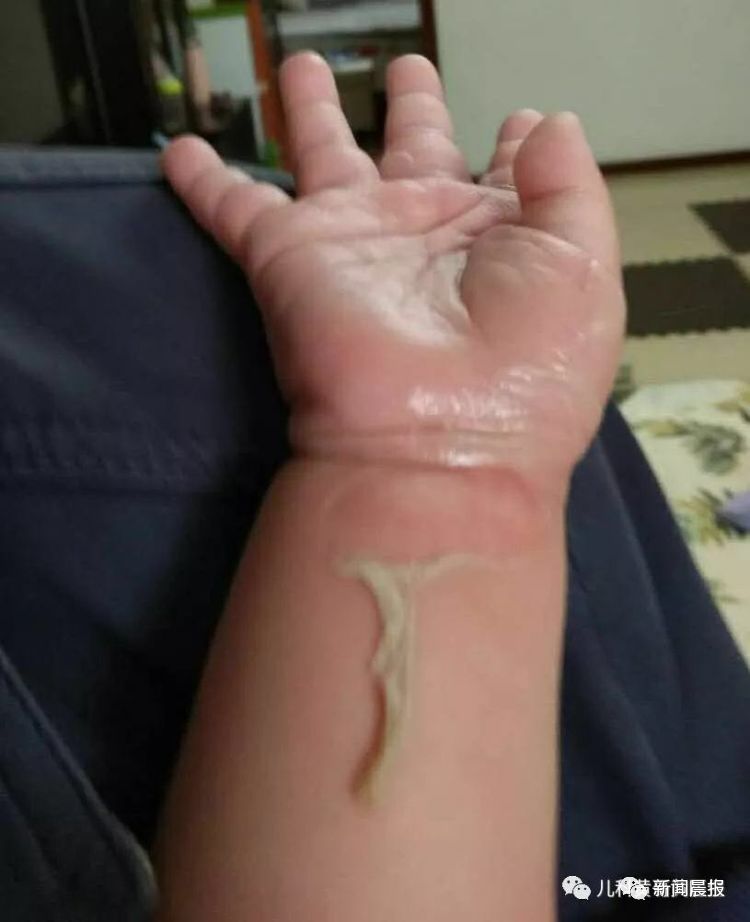 小孩被烫伤家长有法律责任吗,孩子被烫伤用不用去医院