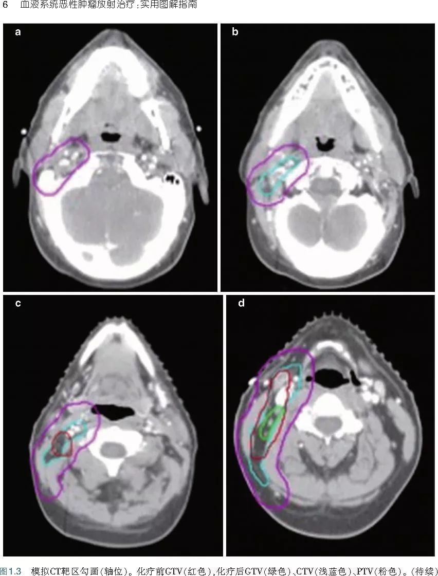 血液系统恶性肿瘤放射治疗：实用图解指南