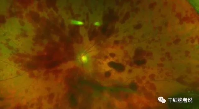 一件发生在美国的干细胞事故，FDA如何处理的？