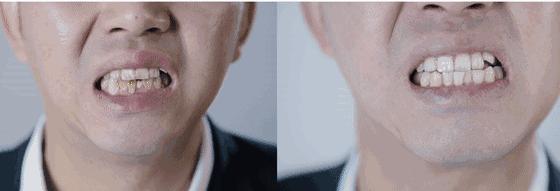 牙龈肿了出血口臭牙黄用什么牙膏,牙龈上火牙膏