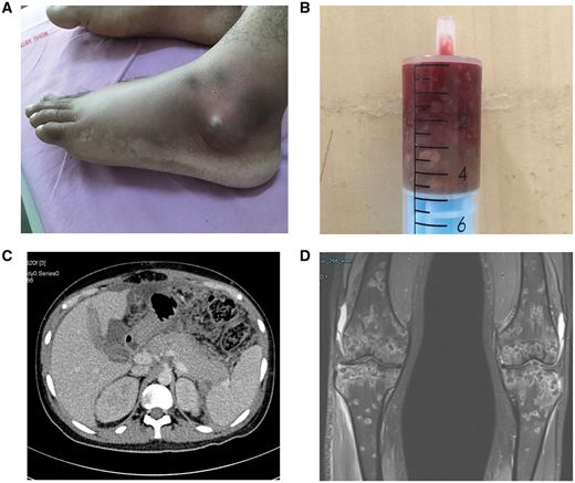 骨梗死是一种什么情况,骨梗死临床表现