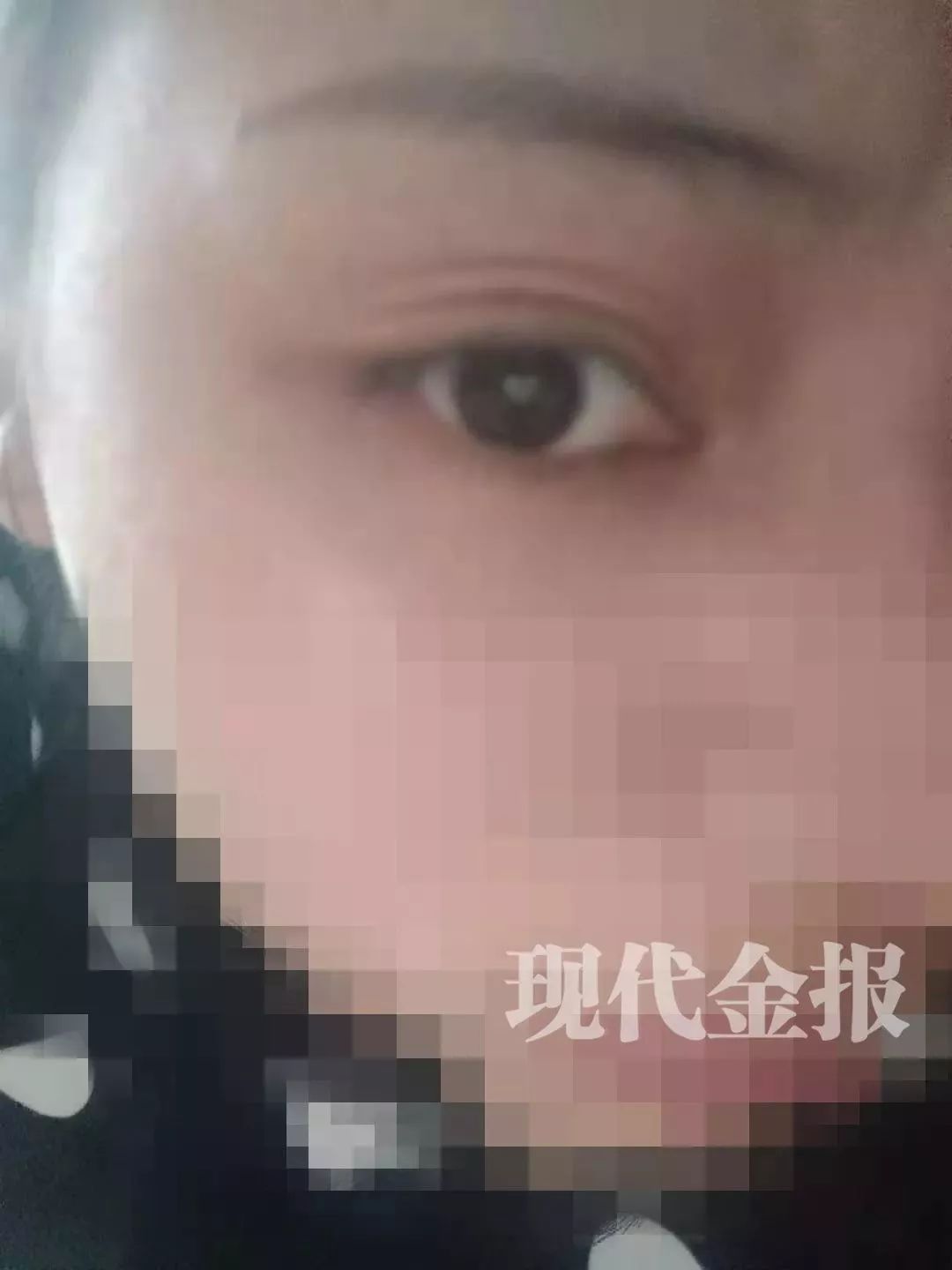 20岁女孩花一万元整双眼皮,四川一女子花3万整容后左眼失明