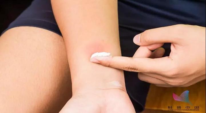 为啥被蚊子咬后越涂炉甘石越肿,被蚊子咬皮肤突然肿起来怎么治