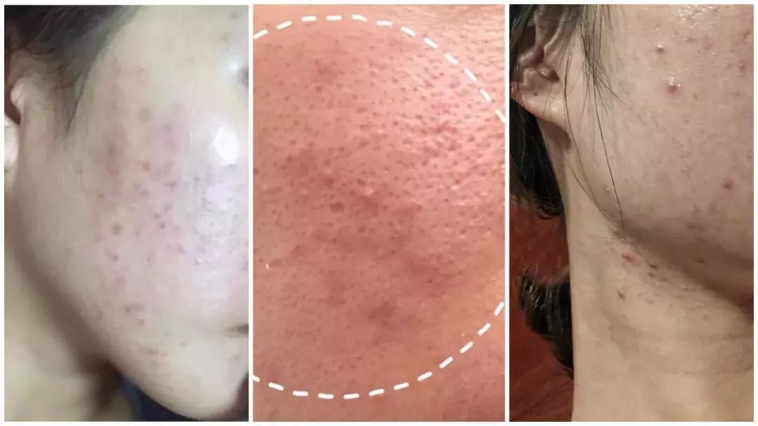 断货王祛痘胶囊,秒杀祛痘化妆品一元