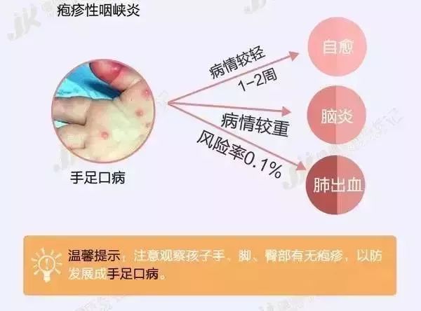 高烧引起疱疹要用什么药,高烧还有带状疱疹