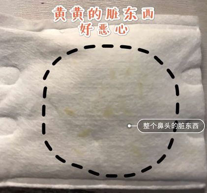 去黑头鼻贴推荐黑头导出液,去黑头的最好办法告别草莓鼻