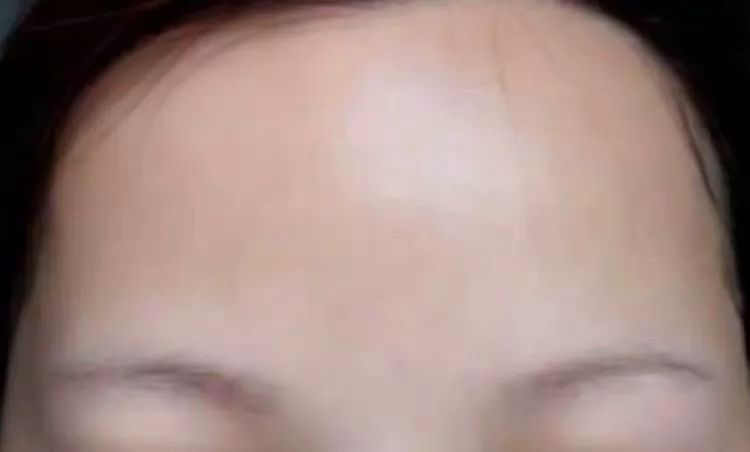 纹眉一周后眉毛还没完全掉痂,纹眉之后我的眉毛不长了