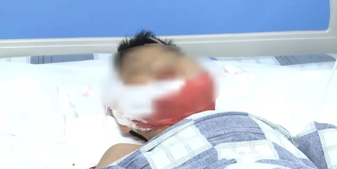 四川小孩被玩伴嘴角撕裂,男童嘴角裂到耳根