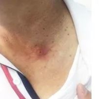 脖子突然一块红痒起泡,男子脖子上突然起疙瘩怎么回事