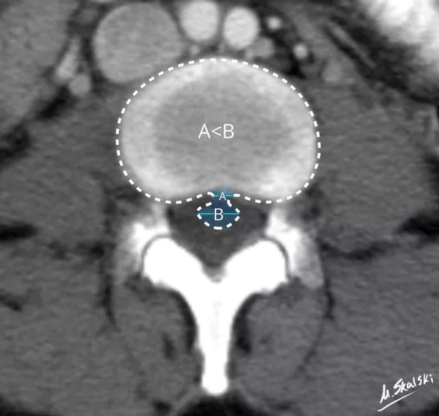 椎间盘膨出、突出、脱出如何鉴别，几幅图让你一目了然