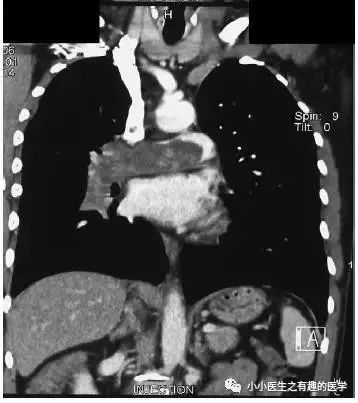 肺动脉分支充盈欠佳是肺栓塞吗,肺动脉缺损不可逆