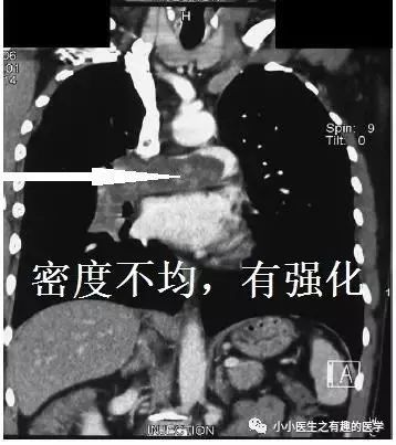 肺动脉分支充盈欠佳是肺栓塞吗,肺动脉缺损不可逆