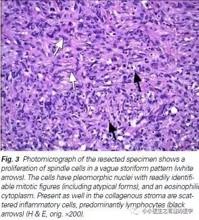 肺动脉分支充盈欠佳是肺栓塞吗,肺动脉缺损不可逆