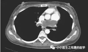 肺动脉分支充盈欠佳是肺栓塞吗,肺动脉缺损不可逆