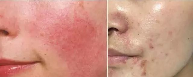 脸上搓出3斤泥！难怪又黄又暗又黑头！10秒给脸蛋“剥壳”，厉害