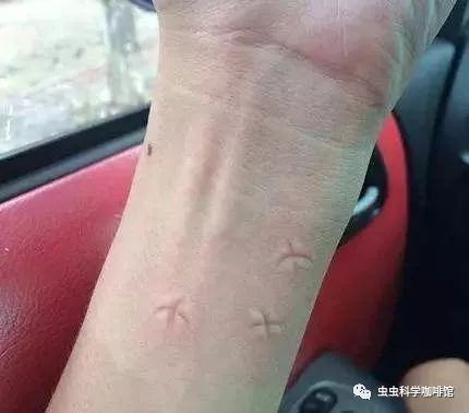 被蚊子咬了痒怎么快速止痒,被蚊子咬了挠痒动作