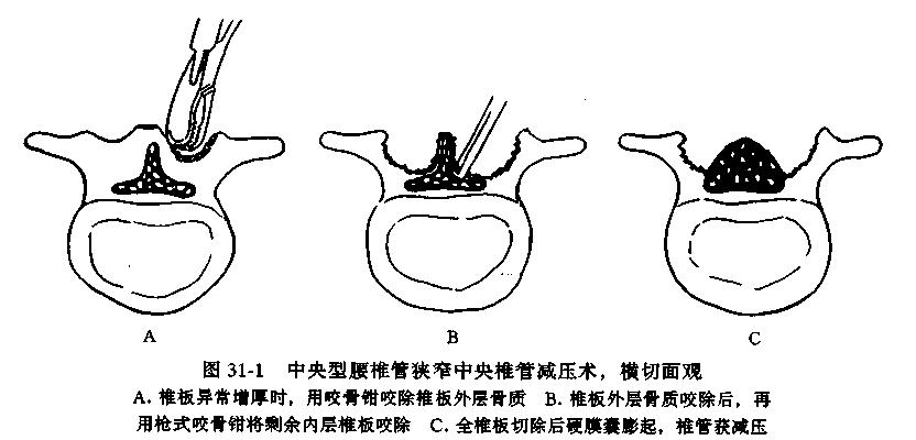 一分钟带你了解腰椎狭窄,椎管狭窄症知识大全