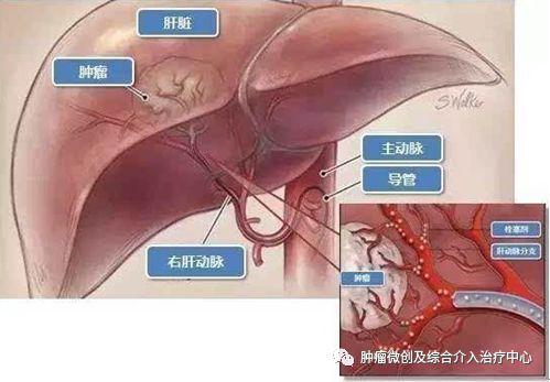 大咯血的抢救药物,支扩栓塞止血后大咯血还会复发吗