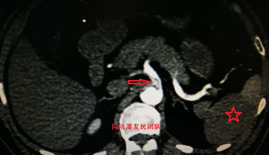 主动脉夹层如何快速确诊,确诊主动脉夹层最可靠办法