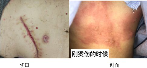 受伤怎样不留疤,受伤后怎样不留疤