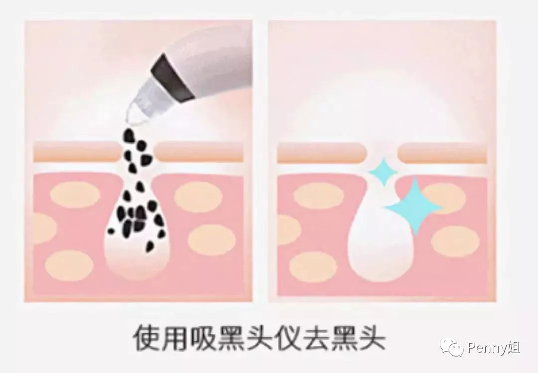 那些年一起挤过的痘痘,那些年我们一起倒过的垃圾