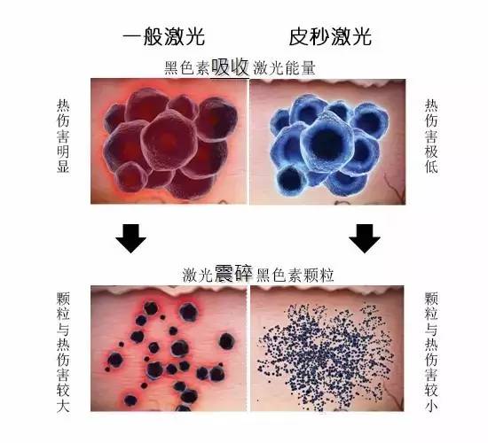 ‘斑’弄是非，超皮秒要你好看