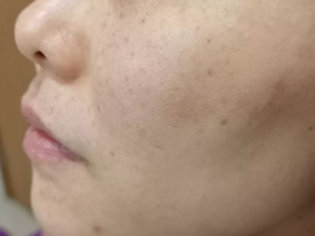 雀斑样痣和雀斑的区别有哪些,雀斑和青褐色痣