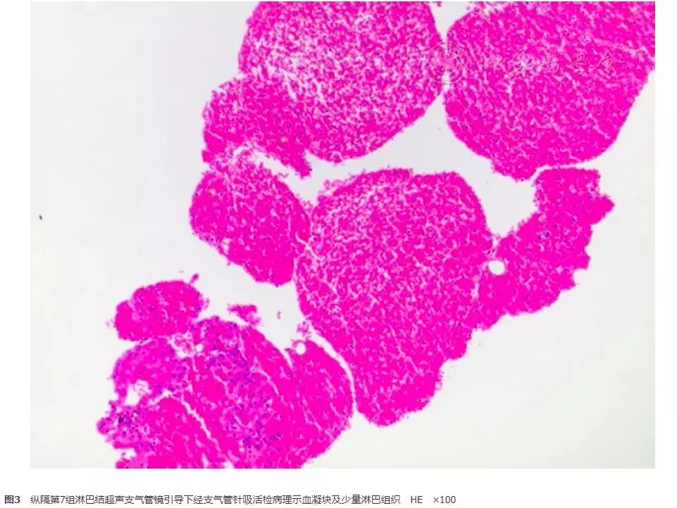 胸腺鳞癌一例并文献复习