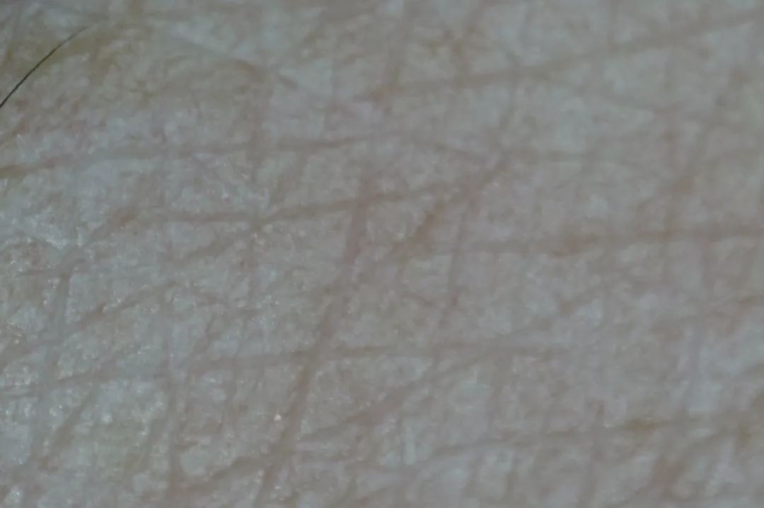 消除眉间法令纹最有效的方法,眉间纹和法令纹医美