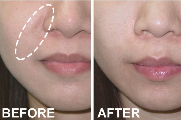 眉间纹和法令纹除皱针能去掉吗,嘴角纹法令纹抬头纹国货推荐