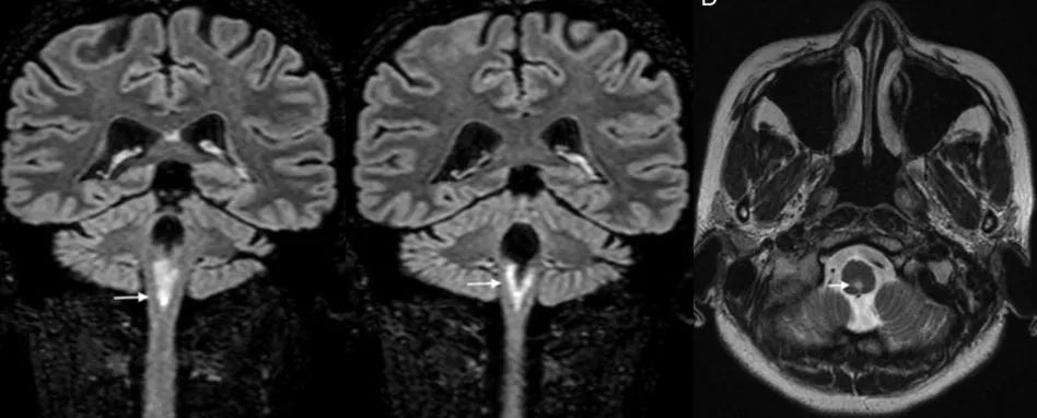 急性脂肪栓塞、神经白塞病、NMOSD极后区综合征丨3分钟读片·第11期