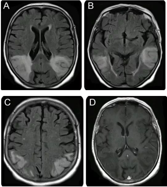 急性脂肪栓塞、神经白塞病、NMOSD极后区综合征丨3分钟读片·第11期