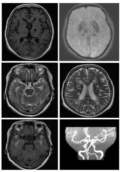 急性脂肪栓塞、神经白塞病、NMOSD极后区综合征丨3分钟读片·第11期