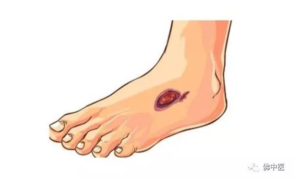 泌尿系结石治疗方法视频动画,泌尿系结石预防措施研究