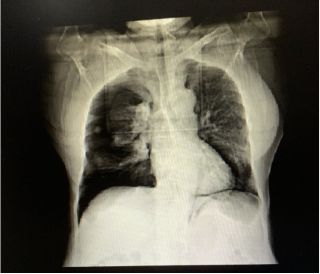 肺组织压缩约10%需要住院吗,肺组织压缩50%复发可能性