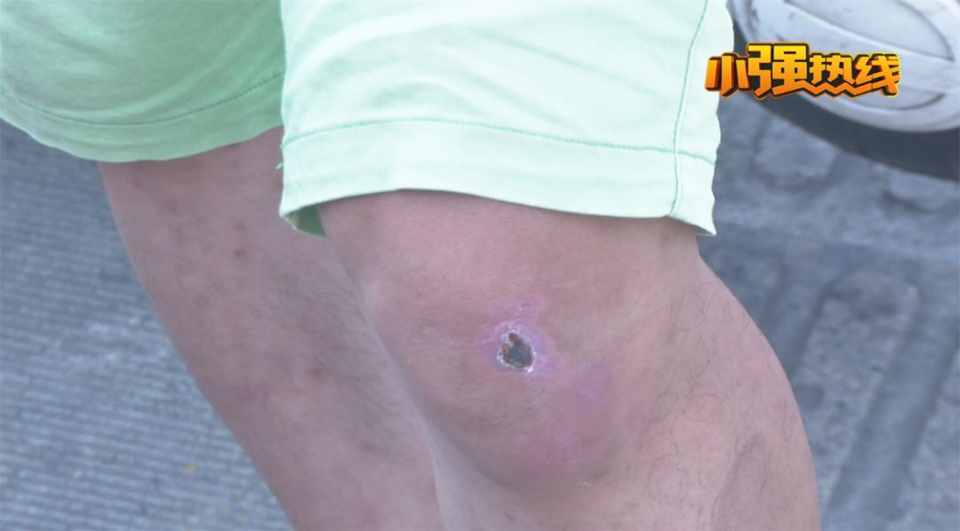 小米平衡车摔骨折保险赔多少,小米平衡车摔伤赔偿