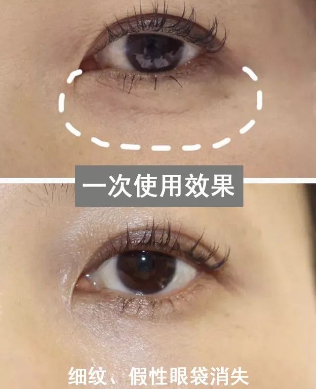 解决眼袋只需3步,不管眼袋多严重用点它