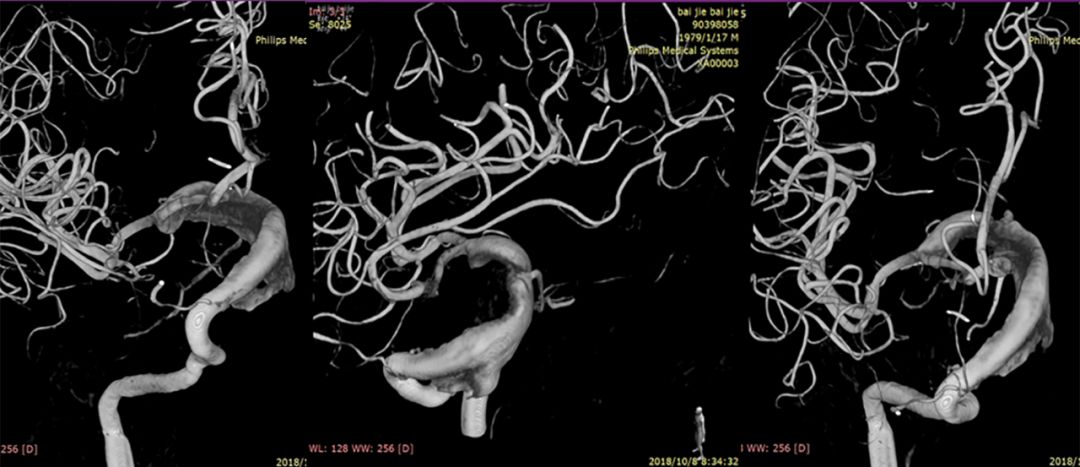 物华天宝·第7期｜脑部长型巨大夹层动脉瘤的4个密网支架桥接治疗复查治愈（附复查CTA结果）